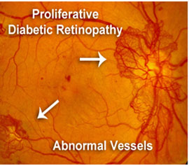 PROLIFERATIVE RETINOPATHY