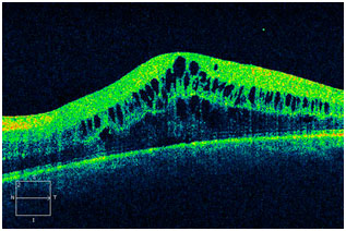 OCT IMAGE OF MACULAR EDEMA