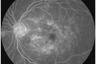 FLUORESCEIN ANGIOGRAPHY