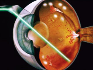 Laser treatment for diabetic retinopathy