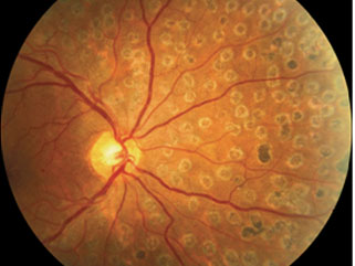 Laser treatment for diabetic retinopathy