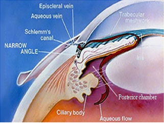 Glaucoma