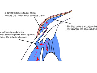 Glaucoma