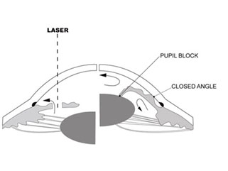 Glaucoma