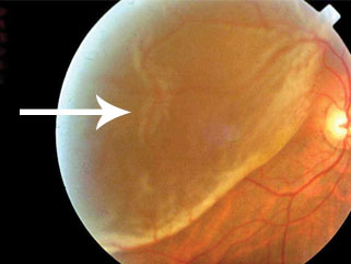 retinal detachment