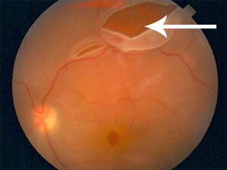 retinal detachment