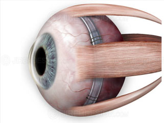 retinal detachment