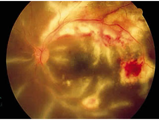 uveitis