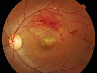 vein occlusion