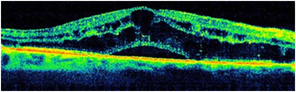 vein occlusion