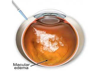 vein occlusion