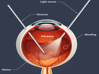 vein occlusion