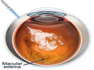 Laser treatment for diabetic retinopathy